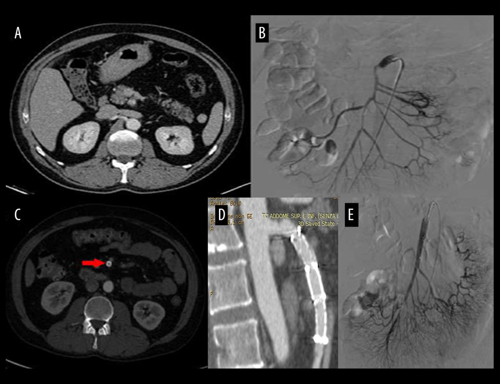 Case 2 involved a 45-year-old White man with a 3-day history of severe abdominal cramping and pain. Abdominal computed tomography (CT) scan and preprocedural angiogram confirmed SID-SMA with hypoperfusion of the bowel loops and cecum (A, B). Follow-up abdominal CT scan showed good patency of the stent lumen (C, arrow; D). Postprocedural angiogram showed good patency of the SMA and ileo-colic artery with improved distal vascularization (E). SID – spontaneous isolated dissection; SMA – superior mesenteric artery.