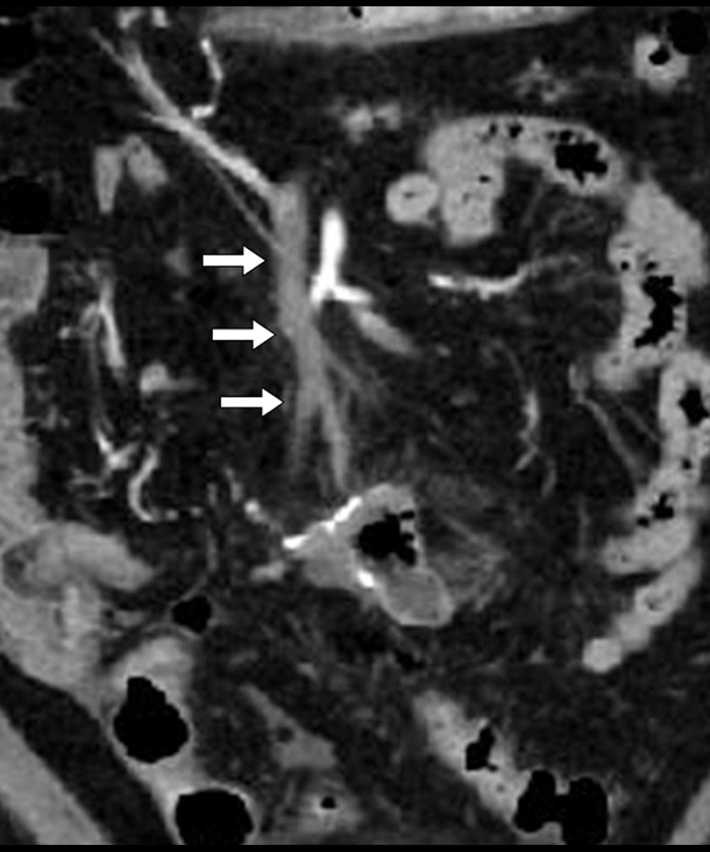 Contrast-enhanced computed tomography reveals thrombosis in the SMV (white arrow head).