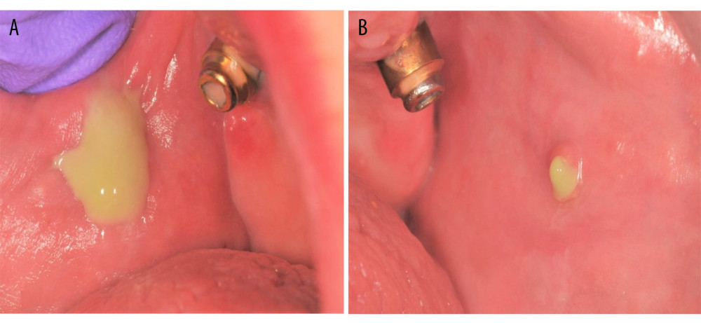 (Case 1) Oozing of pus from the Stensen’s duct (A right and B left) after bilateral parotid gland manipulation.
