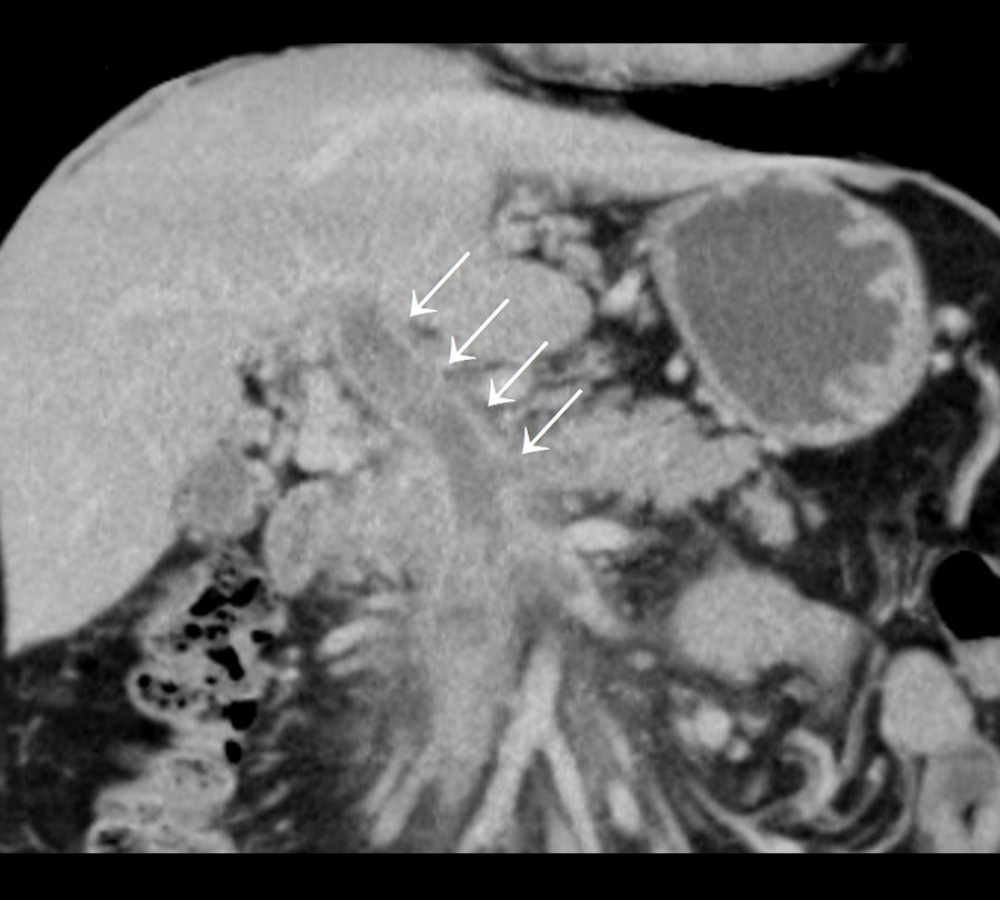 Abdominal CT scan of first portal and mesenteric vein thrombosis. Thrombosis of portal vein and superior mesenteric vein (arrows).