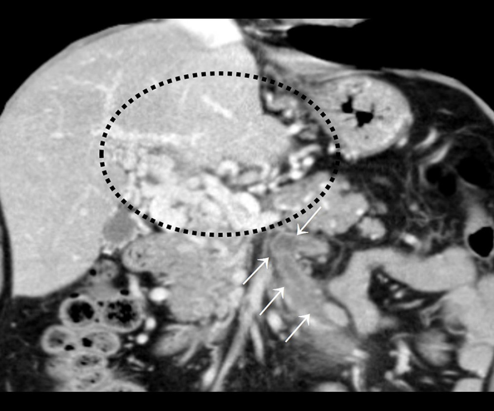 Abdominal CT scan of second portal and mesenteric vein thrombosis. Mesenteric vein thrombosis (arrows) and residual hepatopetal collateral circulation (circle).