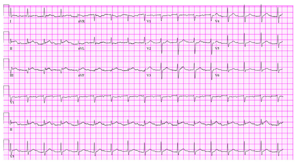 Electrocardiogram showing showed ST elevations in leads II, III, and aVF with a first-degree AV block at a heart rate of 98 beats/minute.