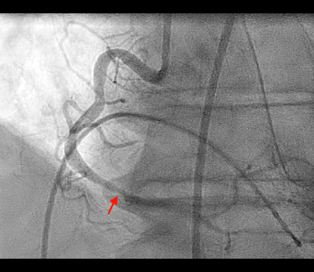 Coronary angiogram of the right coronary artery (RCA) showing evidence of an approximately 60% lesion in the distal RCA (red arrow).