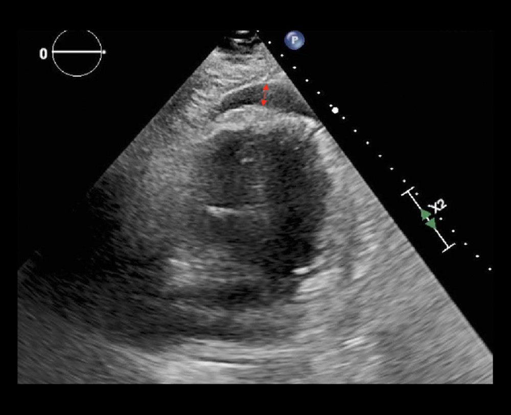 Transthoracic echocardiogram showing a small pericardial effusion measured at 0.9 cm (red double arrow).