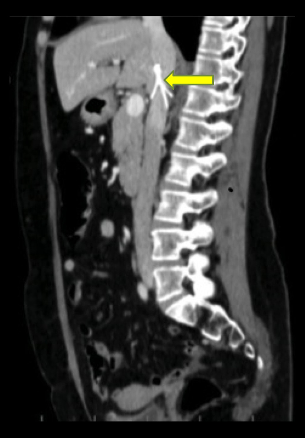 An enhanced CT scan (sagittal view) shows the main filter inside the inferior vena cava (yellow arrow).