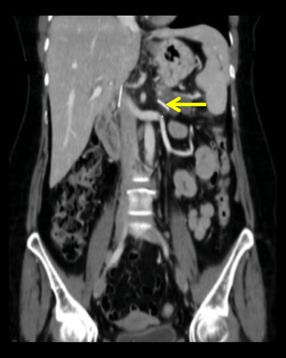 An enhanced CT scan (coronal view) shows the migrated (fractured) IVC filter limb inside the tail of the pancreas (yellow arrow).