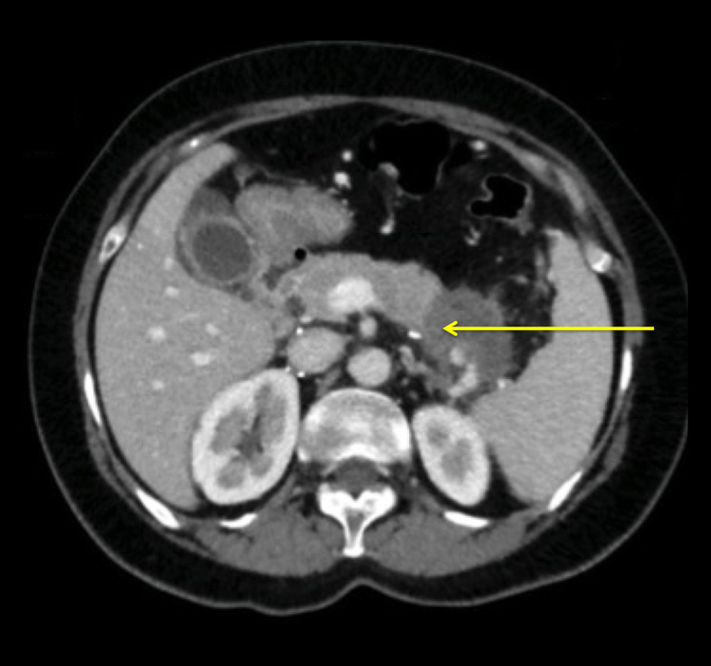 An enhanced CT scan (cross sectional view) shows pancreatic tail hypodensity (arrow) in the area surrounding the filter strut, containing a few cystic lesions.
