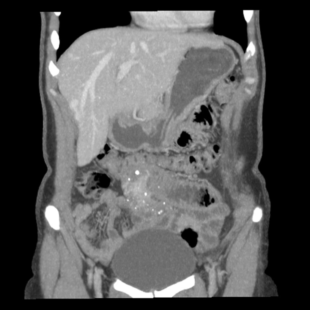 Contrast-enhanced abdominal computed tomography (CT) scan showed focal and concentric thickening of the small intestine measuring 8.3 cm, associated with calcifications, intestinal dilation, mesenteric lymph node enlargement, and vascular dilatation.