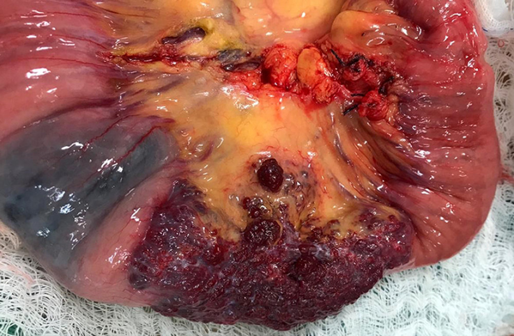 Bluish-colored intestinal lesion measuring 4 to 5 cm in length, removed via exploratory laparotomy.