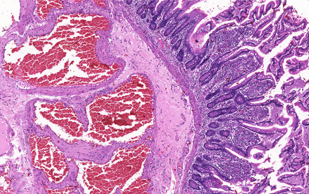 This photomicrograph shows large vascular channels in the submucosa, with blood-filled spaces. The vessel walls are surrounded by a moderate degree of fibrosis, and the endothelium lacks atypia (hematoxylin and eosin staining, ×100).
