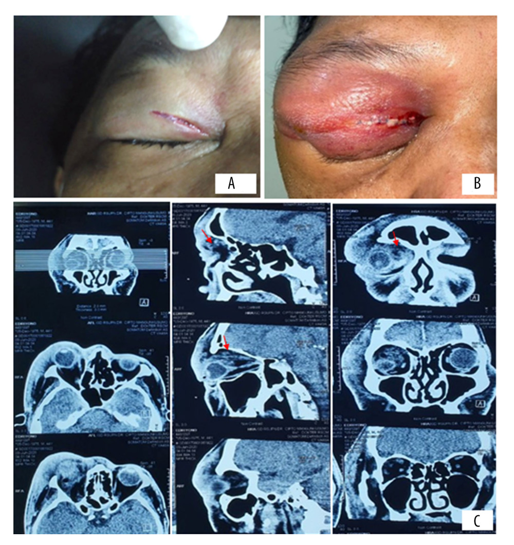 Preoperative photographs and computed tomography (CT) images of the patient: (A) The day of injury, saline irrigation and a simple eyelid repair was performed. (B) Four days after initial treatment, worsening of the right upper eyelid swelling occurred. (C) Orbital CT scan on the fourth day after injury, showing multiple abscesses and pneumo-orbital formations.