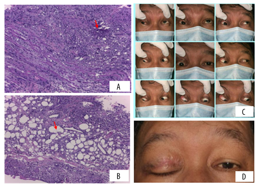 (A) Histological samples showed fragments of orbital tissue including globules of adipose tissue, infiltrated by blood and a number of largely necrotic PMN leukocytes. (B) Some clear vacuoles in different sizes with swiss cheese appearance in between. (C) Four months after surgery, there were upward temporal, central, and nasal gaze restrictions. (D) There was slight ptosis with periorbital edema, which gradually improved.
