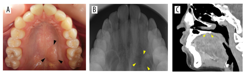 (A) A hemispherical mass on the left side of the hard palate at initial diagnosis (arrowheads). (B) Simple radiographs taken at the intraoral occlusion revealed no bone resorption on the maxilla near the lesion. (C) Sagittal computed tomography image showing no abnormal resorption of the bone contacting the tumor (arrowheads).