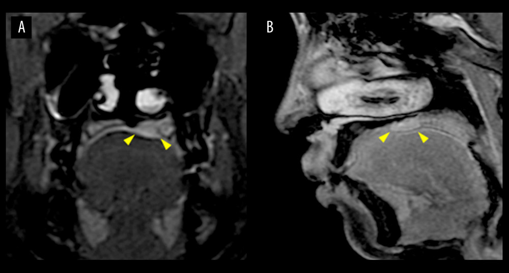 (A) Coronal T2-weighted magnetic resonance imaging (T2WI). Expansile mass lesions present on the left maxillary bone of the hard palate (arrowheads). (B) Sagittal T2WI. No obvious bone resorption was evident (arrowheads).