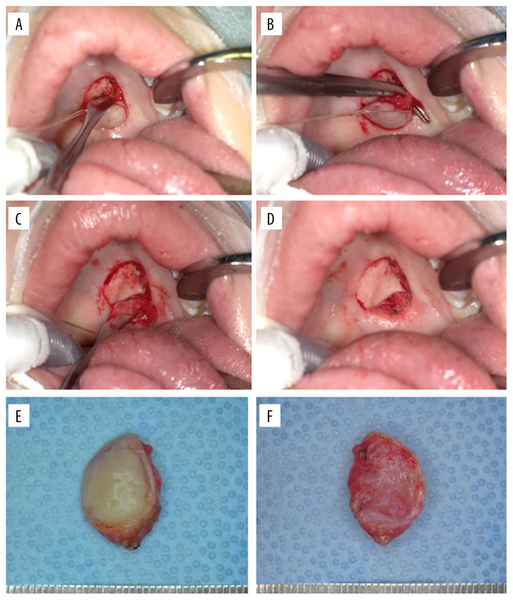 Intraoperative photographs. (A) The lesion was excised along with the mucosa in the superficial layer and the periosteum in the deep layer. (B) A branch of the large palatal nerve contiguous with the tumor was identified. (C) The greater palatal nerve was ligated, cut, and resected under the periosteum. (D) After excision of the lesion, no resorption was observed on the bone surface. (E) The mucosal and (F) periosteal surfaces of the excised lesion are shown.