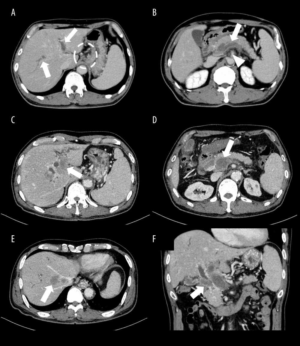 Abdominal contrast-enhanced computed tomography (CT). (A) Abdominal CT performed on admission showing a low-density area in the intrahepatic portal veins without enhancement, suggesting the presence of a thrombus (arrows), with the development of collateral circulation (dotted circle). (B) The low-density area continues to the splenic vein (arrow) and the superior mesenteric vein (arrowhead). The presence of splenomegaly is apparent. (C) Abdominal CT performed in the 8th month after the first assessment showing enlargement of the low-density area in the right branch of the intrahepatic portal vein, with higher density than that detected previously with CT (arrow). The increased density suggested the development of a tumor in the thrombus. (D) The low-density area in the splenic vein is also enlarged in the abdominal CT images obtained in the 8th month after the first assessment (arrow). (E) A low-density tumor-like lesion with a diameter of 4 cm is seen in the S4-8 region in the liver in abdominal CT images obtained in the 8th month after the first assessment (arrow). (F) The low-density area in the portal vein is increased in size, with compression of the common hepatic duct, which is obstructed, in abdominal CT images obtained in the 8th month after the first assessment (arrow).