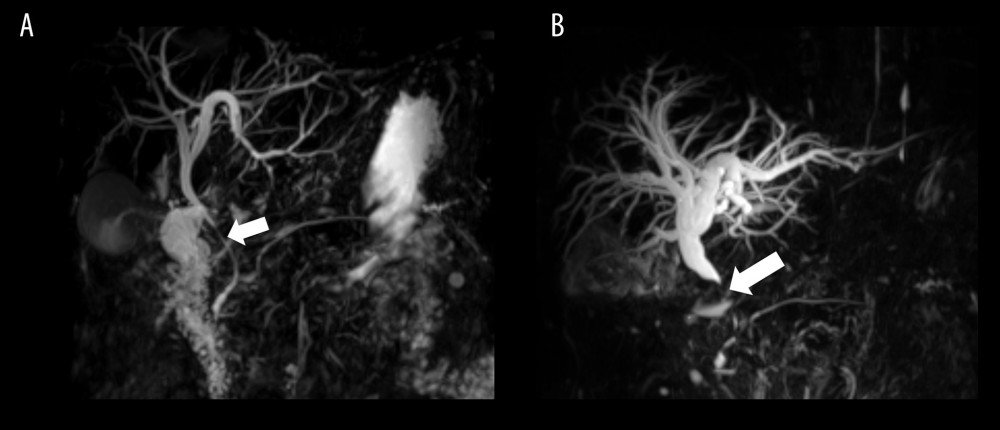 Magnetic resonance cholangiopancreatography (MRCP). (A) Diffuse thickening of the bile duct wall in the middle to lower common bile duct causing stenosis (arrow) with no signs of tumorous lesions in the MRCP images obtained in the 2nd month after the first assessment. (B) Stenosis of the common bile duct (arrow) and dilatation of the intrahepatic bile duct is seen in the MRCP images obtained in the 8th month after the first assessment.