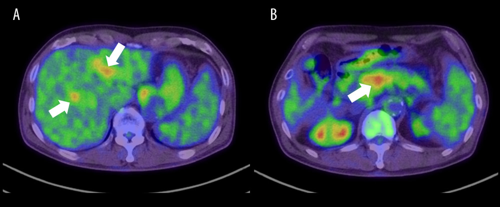 Positron emission tomography-computed tomography (PET-CT) performed in the 3rd month after the first assessment. (A) High uptake of fluorodeoxyglucose is seen in the intrahepatic portal veins (arrows) in PET-CT images at the level of the liver. The standardized uptake value (SUV) max was 4.94 in the early phase and 5.25 in the delayed phase. (B) High uptake of fluorodeoxyglucose is revealed in the splenic vein (arrow) in the PET-CT image at the level of the pancreas.