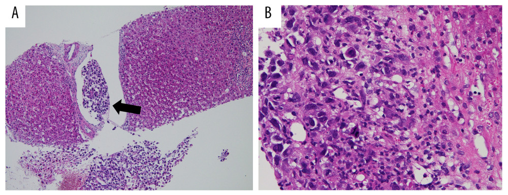 Histopathological examination of the liver biopsy in the 8th month after the first assessment (hematoxylin and eosin staining; original magnification. A: ×40, B: ×100). (A) Undifferentiated atypical cells are present in the intrahepatic portal vein (arrow). (B) Proliferation of polymorphic, spindle-shaped atypical cells are seen infiltrating the liver parenchyma.