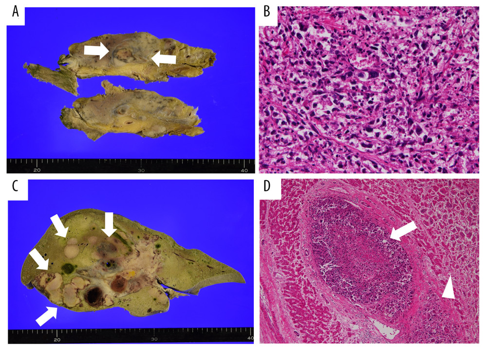 Autopsy findings. (A) Macroscopic findings in the pancreas showing a 4-cm-diameter mass lesion expanding from the pancreatic head to the body (arrows). (B) Histopathological examination of the mass lesion showing proliferation of polymorphic malignant cells with circular- to spindle-shaped nuclei with large and small disparities in diameter (hematoxylin and eosin staining; original magnification ×400). (C) Macroscopic findings in the liver showing extension of the tumor mainly through the intrahepatic portal veins (arrows). (D) Histopathological examination of the liver showing infiltration of the same malignant cells in the intrahepatic portal vein (arrow) and in the liver parenchyma (arrowhead) (hematoxylin and eosin staining; original magnification ×100).
