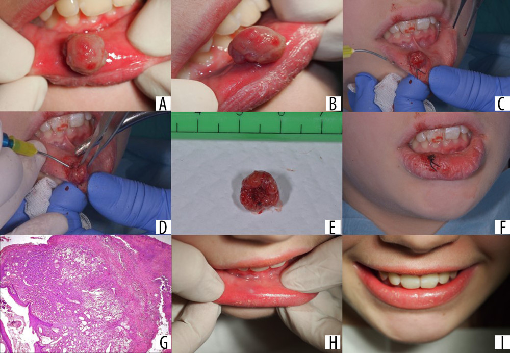 (A, B) Exophytic mass with smooth surface and sessile base (1.5-cm diameter). (C, D) Excision of the lesion with a 980-nm diode laser. (E) Excisional biopsy specimen. (F) Lip after the excision. (G) Microscopic aspect (hematoxylin and eosin staining). (H, I) One-month follow-up.