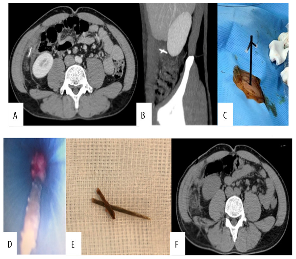 (A, B) Abdominal CT scan before the intervention. The FBs appeared as hyperdensity lesions, located adjacent to each other and between the ascending colon and the right abdominal wall. (C) A plastic 14-F port was used to approach the FBs under the guidance of ultrasonography. (D) The FBs were removed through the port. (E) The FBs were 2 pieces of a wooden toothpick (11 and 21 mm). (F) The patient’s post-intervention abdominal CT scan showed that the FBs had been completely removed.