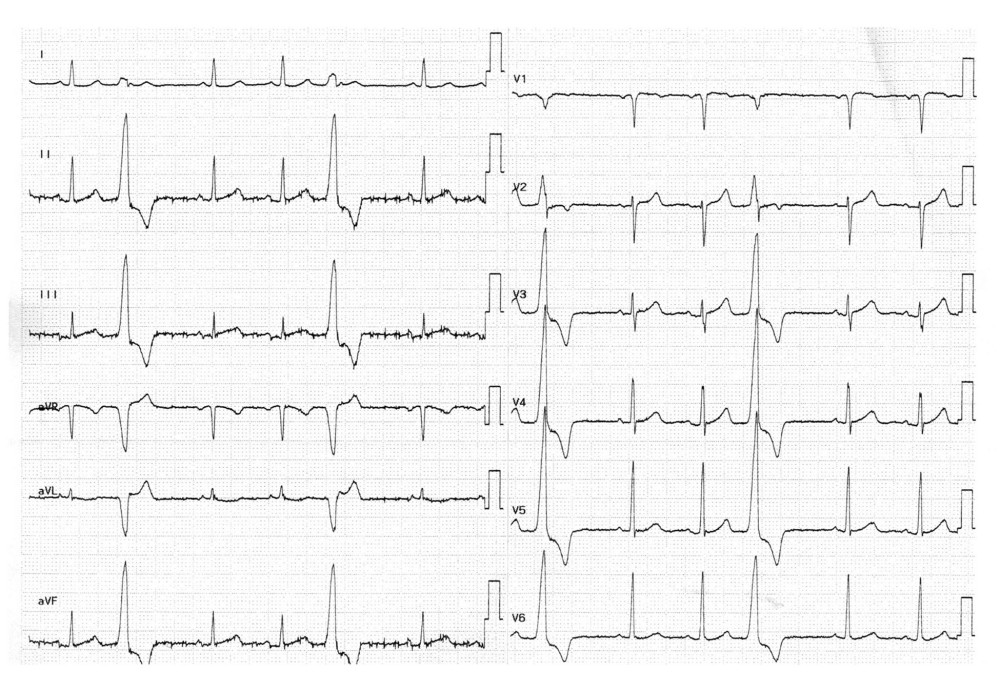 Initial 12-lead electrocardiogram.
