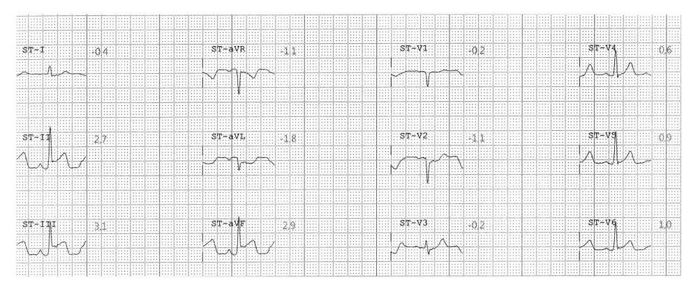 Derived 12-lead electrocardiogram from continued ST-segment Monitoring in patient with occult inferior ST-segment elevation.