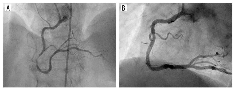 Coronary angiography before and after percutaneous coronary intervention. Coronary angiography showing a stenosis of the second segment of the right coronary artery in panel (A) and the results after percutaneous coronary intervention in panel (B).