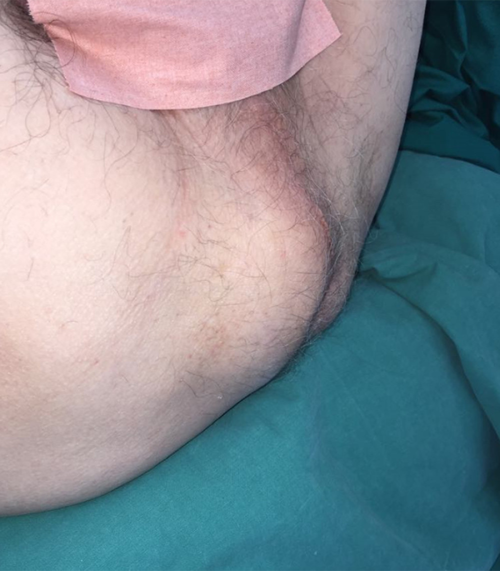 The solitary fibrous tumor caused a swelling of the perineum and right gluteal region.
