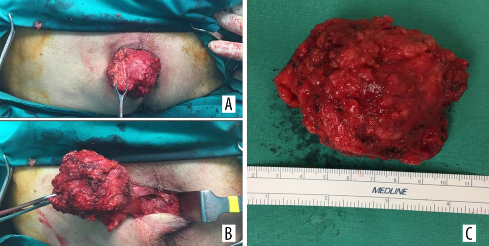 (A) Intraoperative image of complete excision of the solitary fibrous tumor in the perineal region. (B) The tumor close to the external anal sphincter muscle. Complete excision was performed without sacrificing any muscle fibers. (C) The specimen after complete excision of the mass.