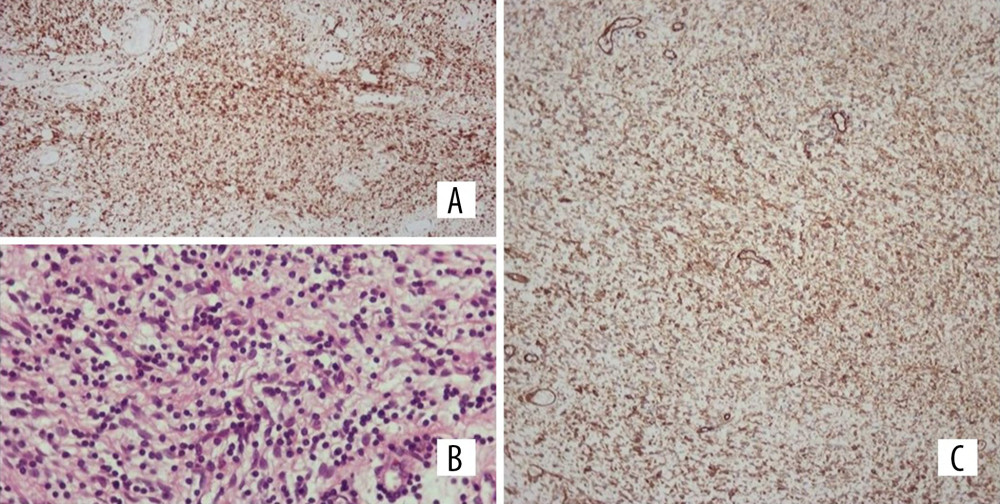 (A) Immunohistochemical stain for Bcl-2 was positive (×100). (B) High-power view demonstrating strong positivity for the CD34 immunohistological stain. (C) Hematoxylin-eosin stain photograph in magnification (×400), showing the characteristic patternless pattern.