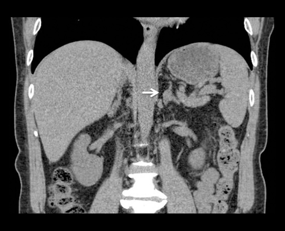 CT: A 1.3-cm oval lesion at left adrenal gland (arrow).