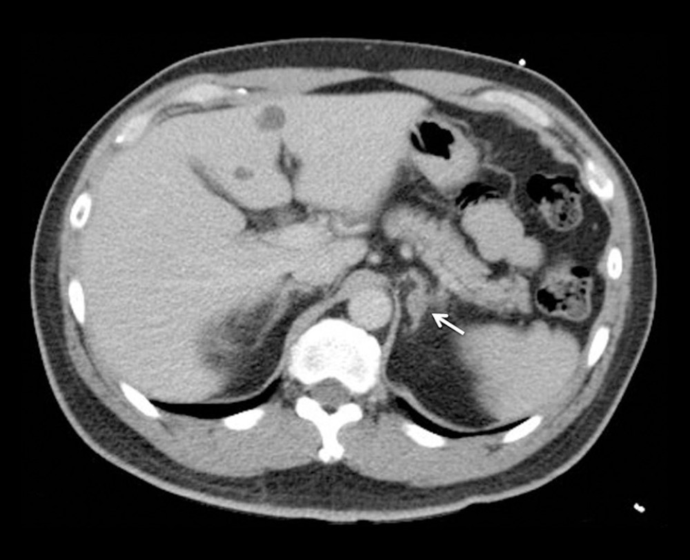 CT: A 1.5-cm oval mass at left adrenal gland (arrow).