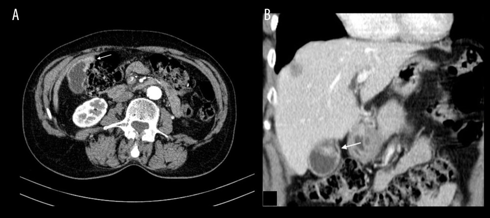 Computed tomography scan. (A) Sagittal image. (B) Coronal image The gallbladder is distended, with slightly irregular parietal thickening (white arrow), mainly involving the vesicular fundus. There are no changes in the liver, except some biliary cysts.