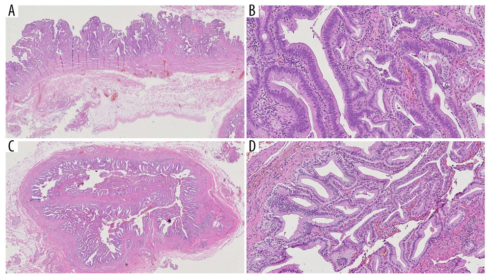 Hematoxylin & eosin-stained histological sections. (A) Magnification ×40. (B) Magnification ×200. (C) Magnification ×40. (D) Magnification ×200. The intestinal phenotype is intracholecystic papillary neoplasm (ICPN). Morphologically, the ICPN has complex tubulo-papillary epithelial growth with pseudostratified nuclei and basophilic cytoplasm. Mitotic activity is scarce and essentially on the basal side of the epithelium.