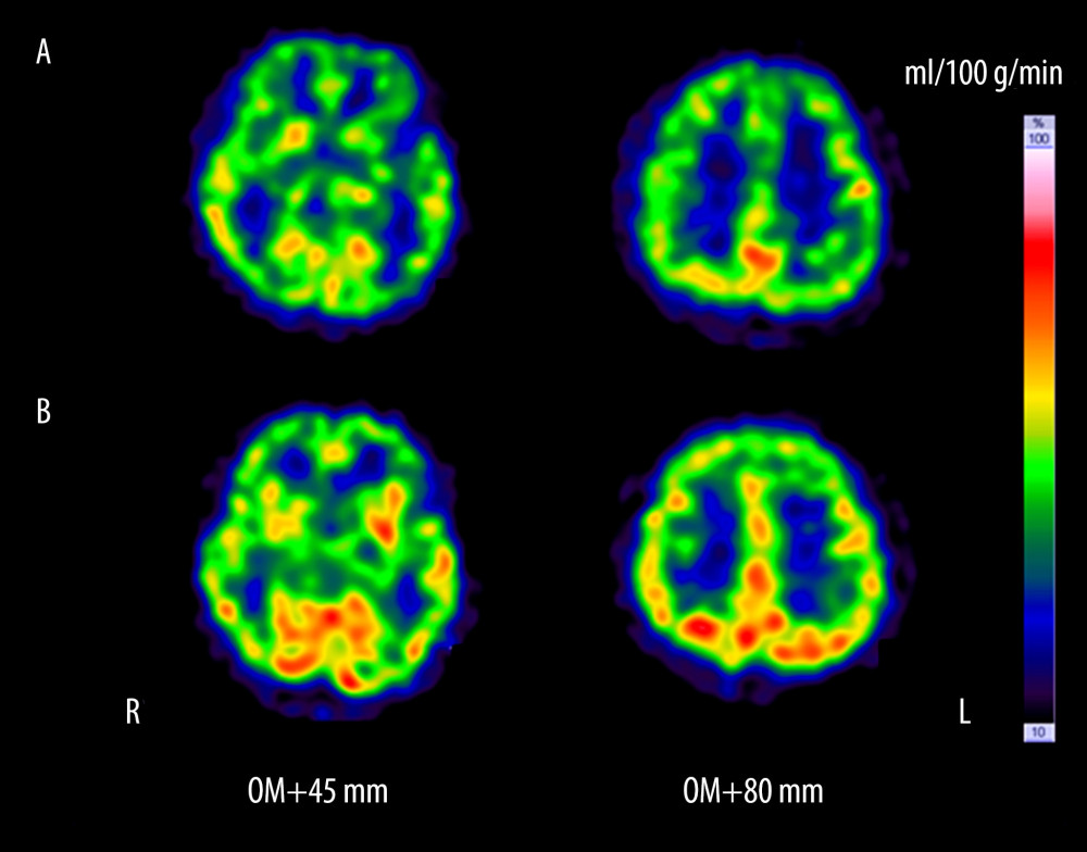 Single-photon emission computed tomography with 99mTc-ethylcysteinate dimer images obtained in November of 2019 (A) and in December of 2019 (B). OM – orbitomeatal plane.