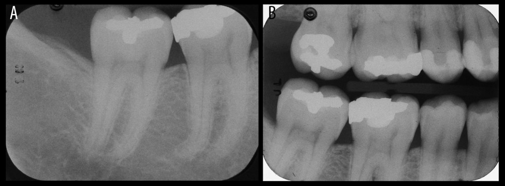 Initial radiographs to rule out a dental origin of dental pain. (A) Periapical radiograph. (B) Bitewing radiograph.