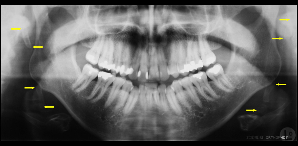 Initial post-surgical presentation. Arrows indicate the beginning and end of the 2 segments left on both sides after the styloidectomy.