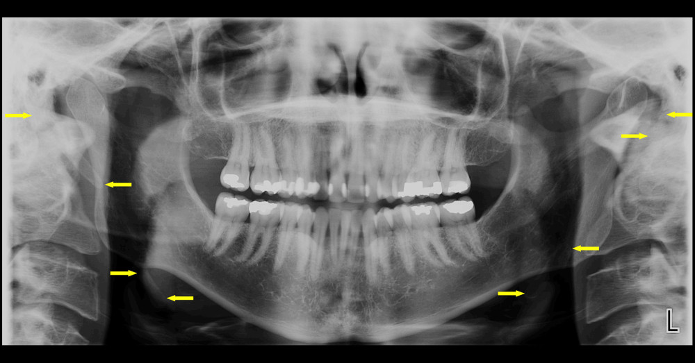 Panoramic radiograph taken 13 years following surgical resection to evaluate recalcifications. Arrows indicate segments remaining on both sides. No recalcifications are noted.