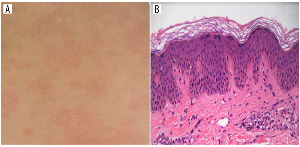 Erythematous maculopapular rash on the lower right limb (A); Granulocytic infiltrate with karyorrhexis in the papillary derma (B).