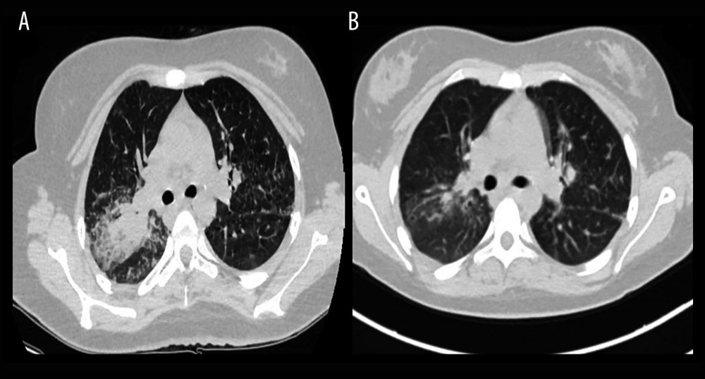 Contrast computed tomography (CT) comparison images of the pulmonary right upper-lobe consolidation with air bronchogram upper-lung infiltrates at the time of hospital admission (A) and after 6 months of treatment (B).