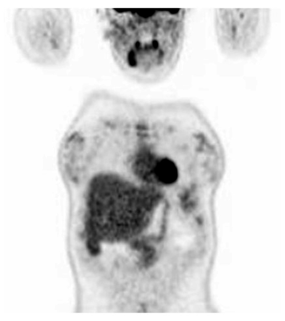 18Fluorodeoxyglucose PET/CT scan at 6 months follow-up, showing increased, not heterogeneous, radiotracer uptake within the right upper pulmonary lobe and multiple bilateral paratracheal, subcarinal, and hilar lymph nodes.