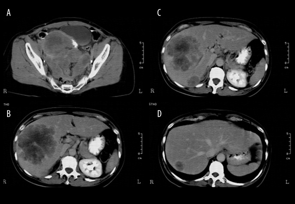 Computed tomography scan from Case 1 at diagnosis. (A) The pelvic tumor. (B–D) The extensive metastatic lesions in the liver.