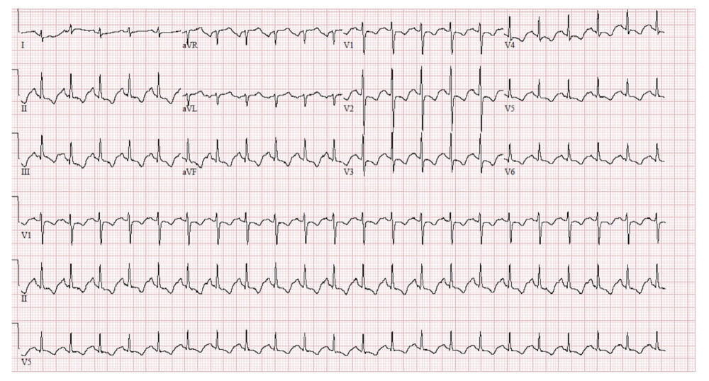Electrocardiogram revealing sinus tachycardia with ST depressions anteriorly with T wave inversions inferiorly and anterolaterally.