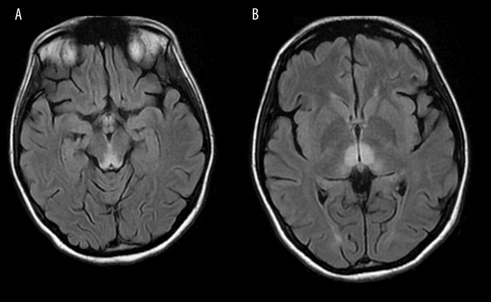 (A) MRI T2 FLAIR image revealing hyper intensity at mammillary bodies. (B) MRI T2 FLAIR image revealing hyperintensity at the thalamus.