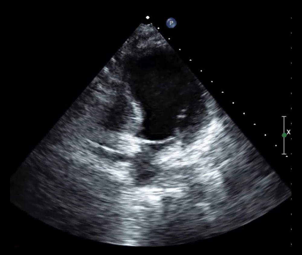 Echocardiogram of apical 4-chamber view with apical ballooning of left ventricle.