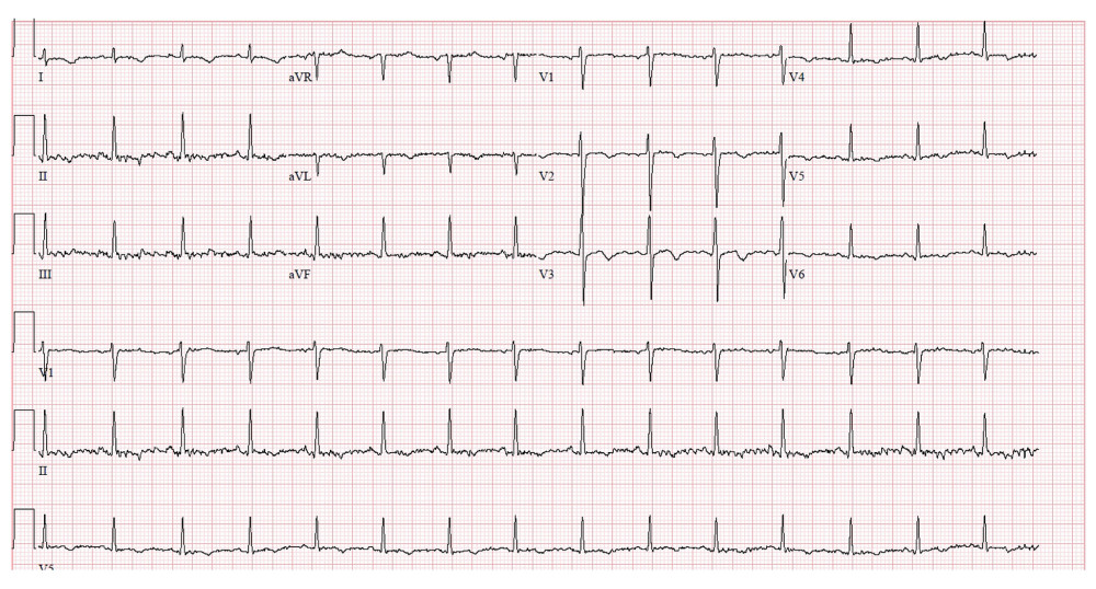 Electrocardiogram revealing near-complete resolution of T wave abnormalities.
