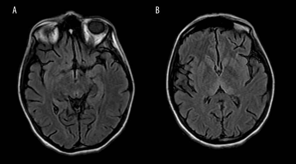 (A) MRI T2 FLAIR image at week 4 follow-up revealing resolution of hyperintensity at mammillary bodies. (B) MRI T2 FLAIR image at week 4 follow-up revealing resolution of hyperintensity at the thalamus.