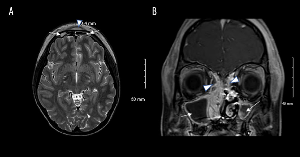 (A). Orbit and brain MRI with contrast shows 5×0.8×4 cm of frontal scalp subgaleal rime enhancing fluid collection, showing subgaleal abscess (arrow head) with mild restricted diffusion within the frontal calvarium, compatible with early changes of osteomyelitis. Moderate fluid collection is shown in underlying frontal sinuses (arrows). (B) MRI brain and orbit shows fluid throughout maxillary sinuses, with mild mucosal thickening bilaterally (arrows). Fluid and mucosal thickening within ethmoid air cells is shown (arrow heads). The findings show acute and chronic sinusitis.